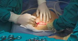 Doctor making an incision for a Cesarean section birth